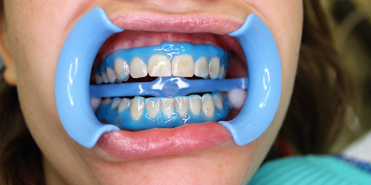 Методы отбеливания зубов. Отбеливание зубов. Химическое отбеливание зубов. Кабинетное отбеливание зубов. Профессиональное отбеливание.